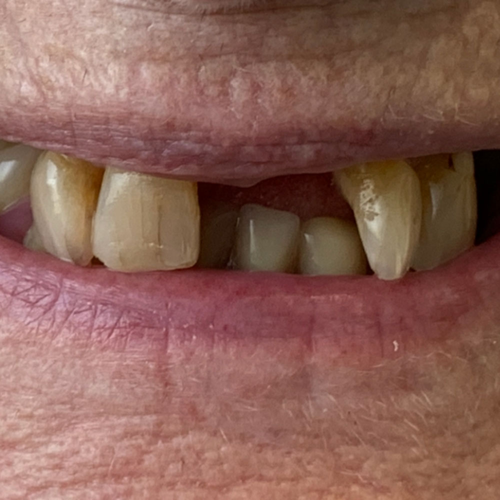 Partial dentures, before - The Denture Clinic, Broadstairs